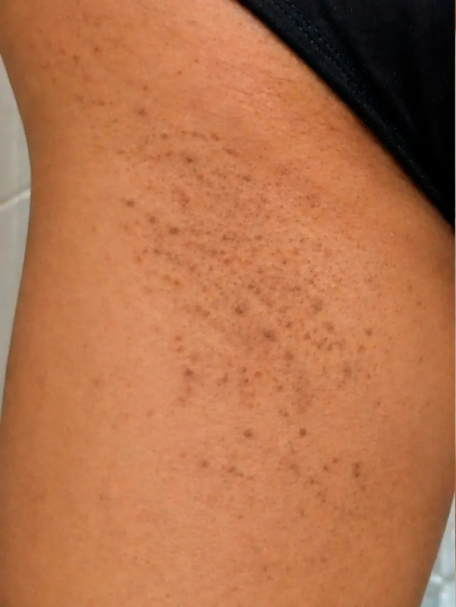 Foliculite na virilha antes do uso do Sérum Clareador Maxfem