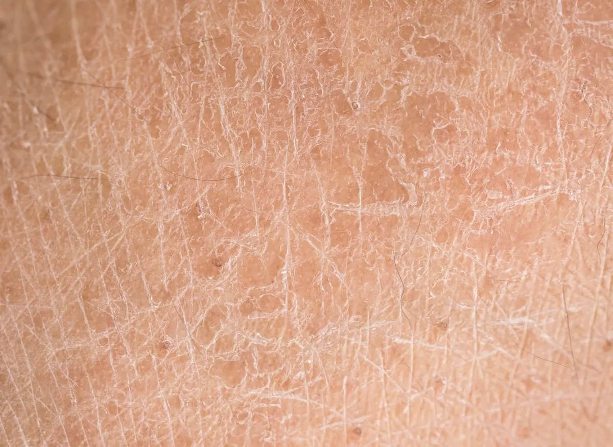 Close da pele ressecada e áspera, com textura repuxada